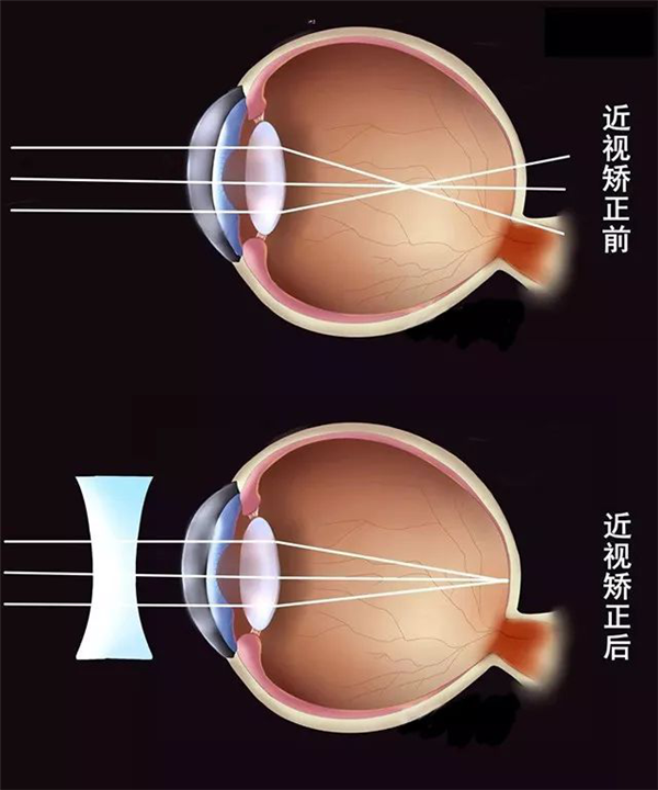 狐大医 | 手术可以治愈近视？并不能减少近视相关的并发症发生__狐大医 | 手术可以治愈近视？并不能减少近视相关的并发症发生