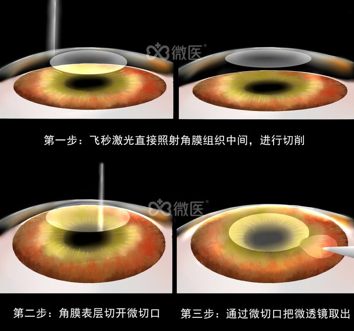 狐大医 | 手术可以治愈近视？并不能减少近视相关的并发症发生_狐大医 | 手术可以治愈近视？并不能减少近视相关的并发症发生_