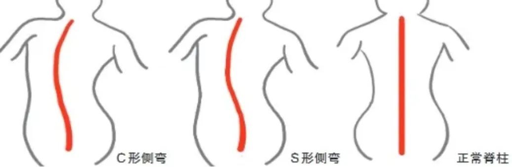 _假胯宽怎么坐可以矫正_怎么自测乳腺堵没堵