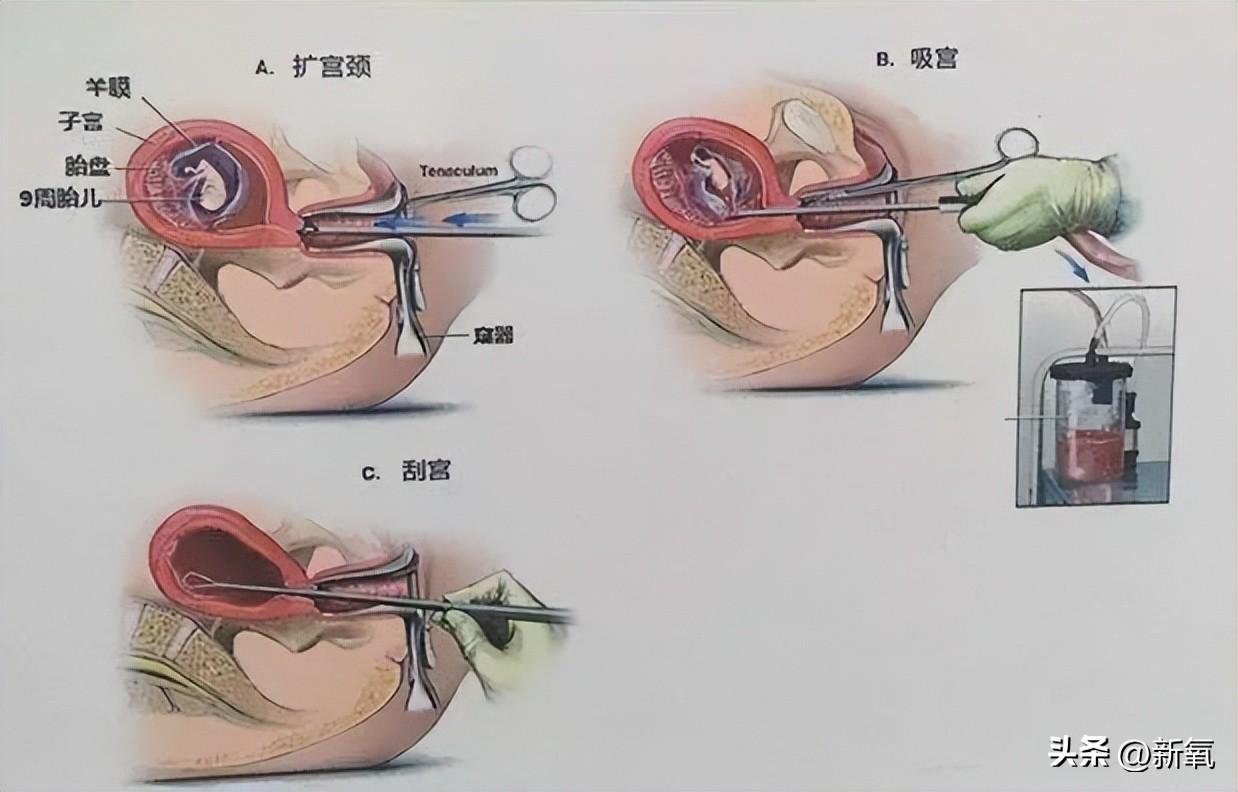 宫腔取胚术是骗局吗_宫腔取胚术收费标准_宫腔取胚术是怎么样过程视频