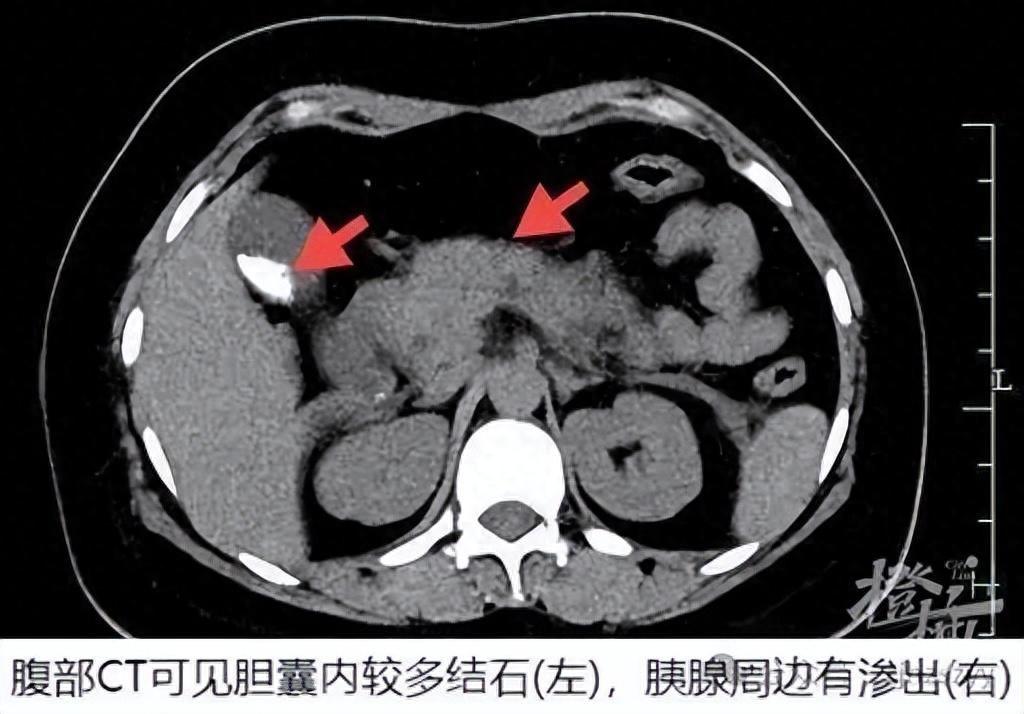 _一口气干掉4只，25岁女子连夜抢救！专家提醒：餐桌上有这道菜的注意了_一口气干掉4只，25岁女子连夜抢救！专家提醒：餐桌上有这道菜的注意了