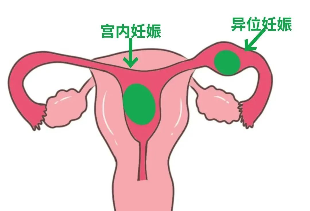 双胎妊娠综合症__双胞胎异常妊娠