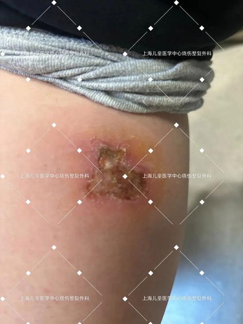 电热毯会烧坏吗_电热毯会不会造成触电事故视频_